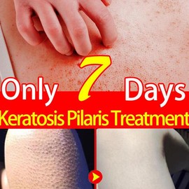 Repair Chicken Skin Body Scrub Keratosis Pilaris Lotion ffor Strawberry Legs  Dark Spot Removal KP Bump Smooth Lotion Skin Care