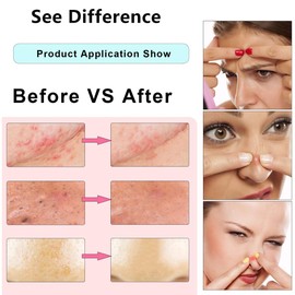 Blackhead Remover Tool Kits, Professional Stainless Pimple Comedone Extractor Tools for Removing Blackhead, Whitehead,Popping,Pimple, Acne with a Box-5PCS