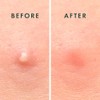 Rael Hydrocolloid Acne Pimple Healing Patch (2 Pack)