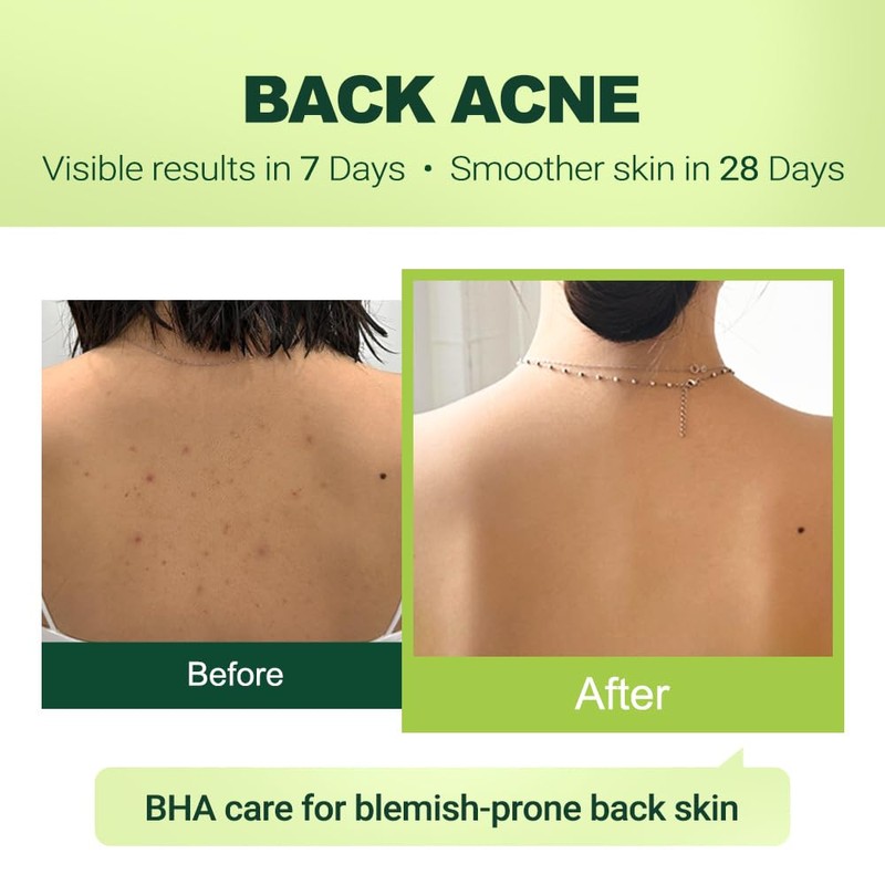 pure.tiful 2% Salicylic Acid (BHA) Serum for Acne & Blackheads