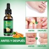 Líquido Para Hongos En Las Uñas-tratamiento Para Uñas