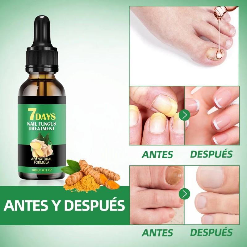 Líquido Para Hongos En Las Uñas-tratamiento Para Uñas