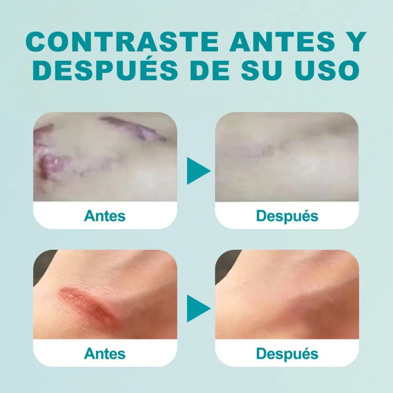 Gel Para Cicatrices Cara Cuerpo Crema Reparar Cicatrices 20g