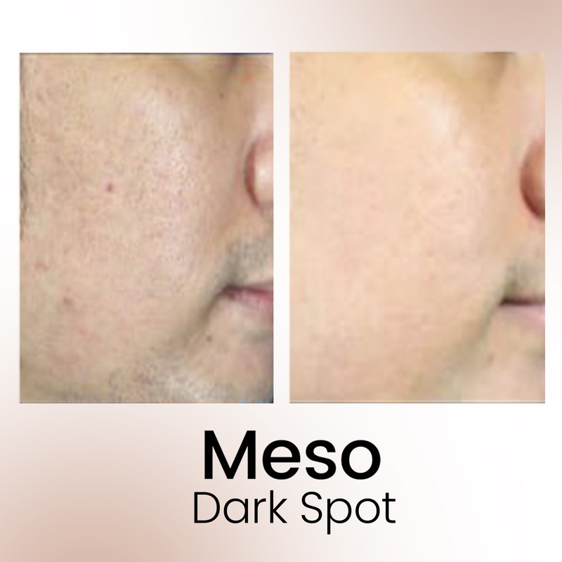 Relumins Intense Glow Meso Dark Spot Serum Set