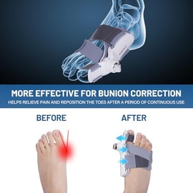 Bunion Corrector for Women & Men with Infinitely Adjustable Knob, Orthopedic Bunion Splint for Big Toe Suitable for Left/Right Feet Hallux Valgus Relief (1PCS)