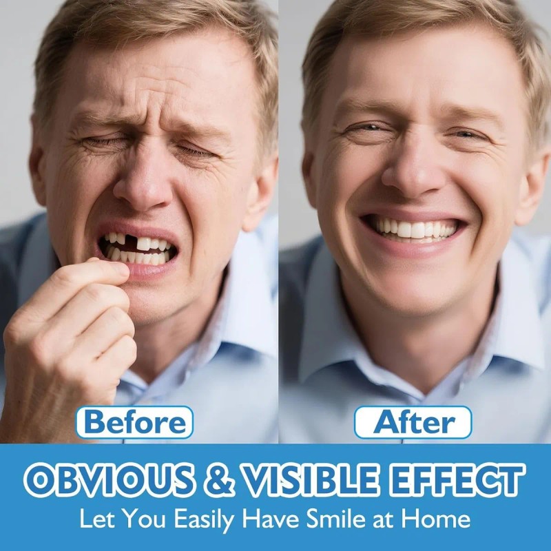 Dientes Postizos Moldeables Carillas Dentales