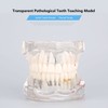 Detachable Dental Model Dental Disease Teaching Study Typodont Demonstration Tooth