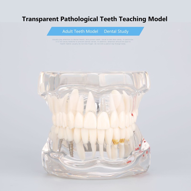Detachable Dental Model Dental Disease Teaching Study Typodont Demonstration Tooth