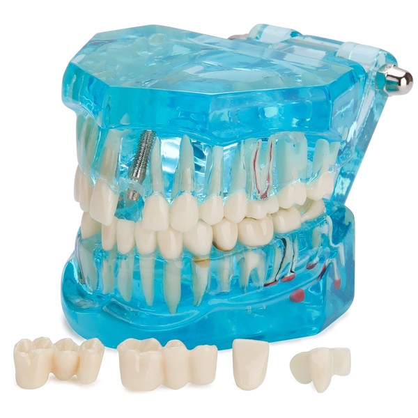 LVCHEN - Modelo de dientes de implante dental transparente, modelo