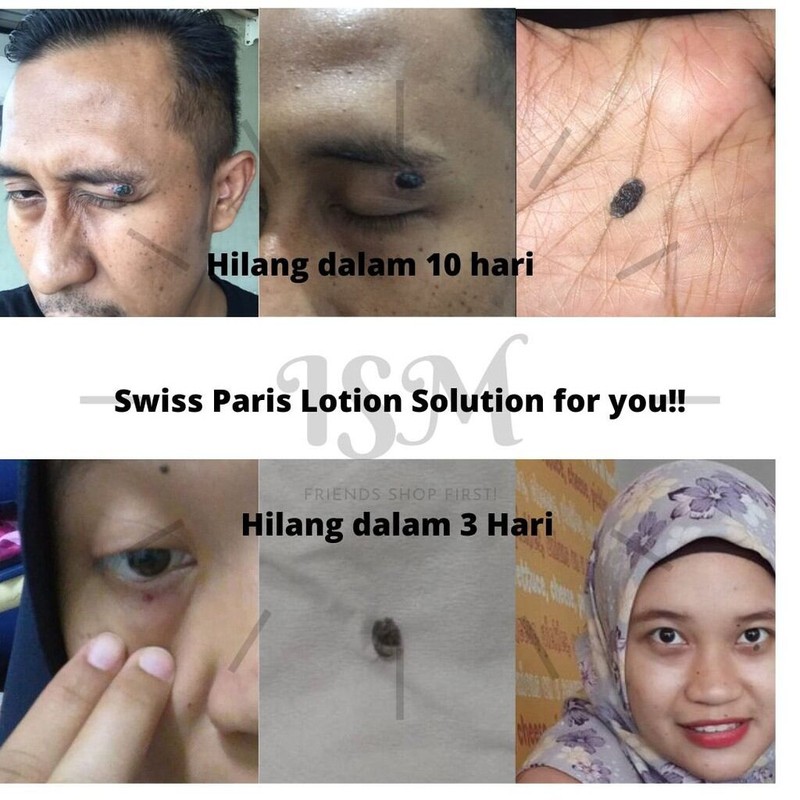 ( READY STOCK ) Swiss paris lotion penghilang kutil tahi