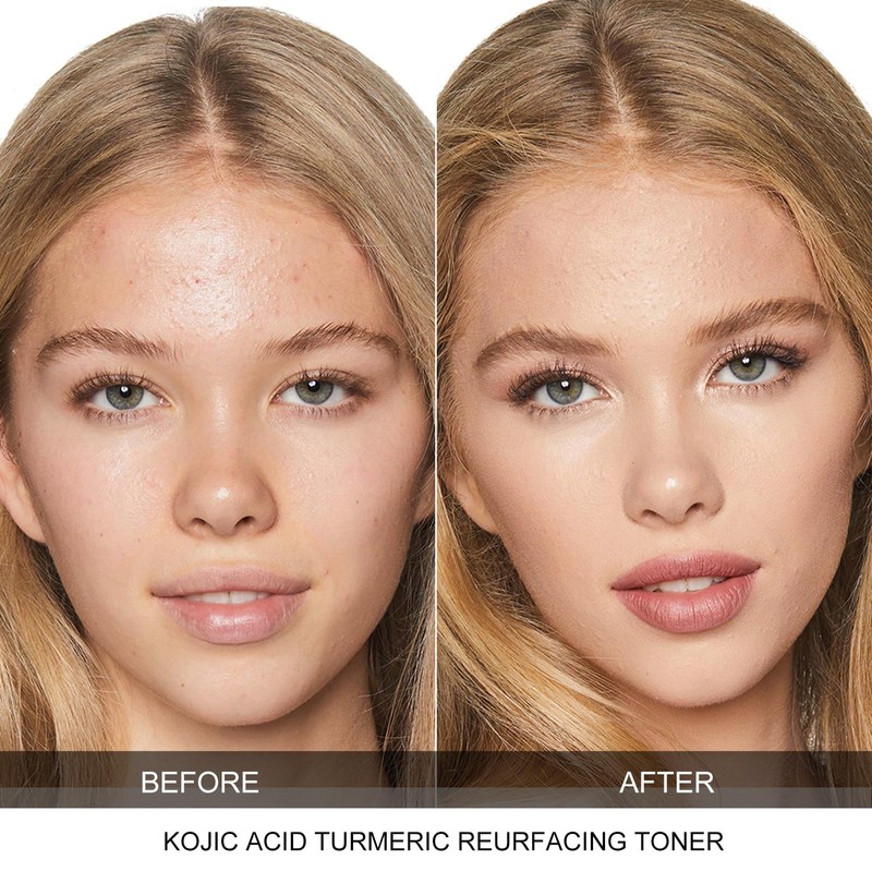 Kojic Acid & Turmeric Face and Body Toner, Exfoliating Toner