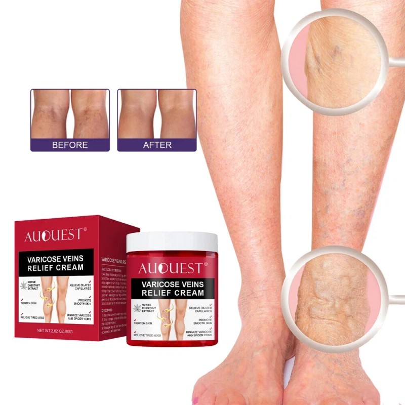 Varicose Veins Relief
