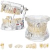 Outus Disease Teeth Model Dental Implant Teeth Model with Removable