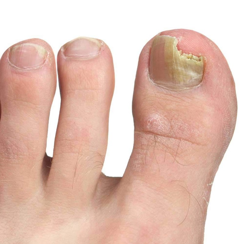 Pronail Plus Fungal Nail Solution 10 ml Brush Application