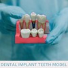 Windplusya Dental Implant Model 4 Times Implant Teeth Model, Analysis