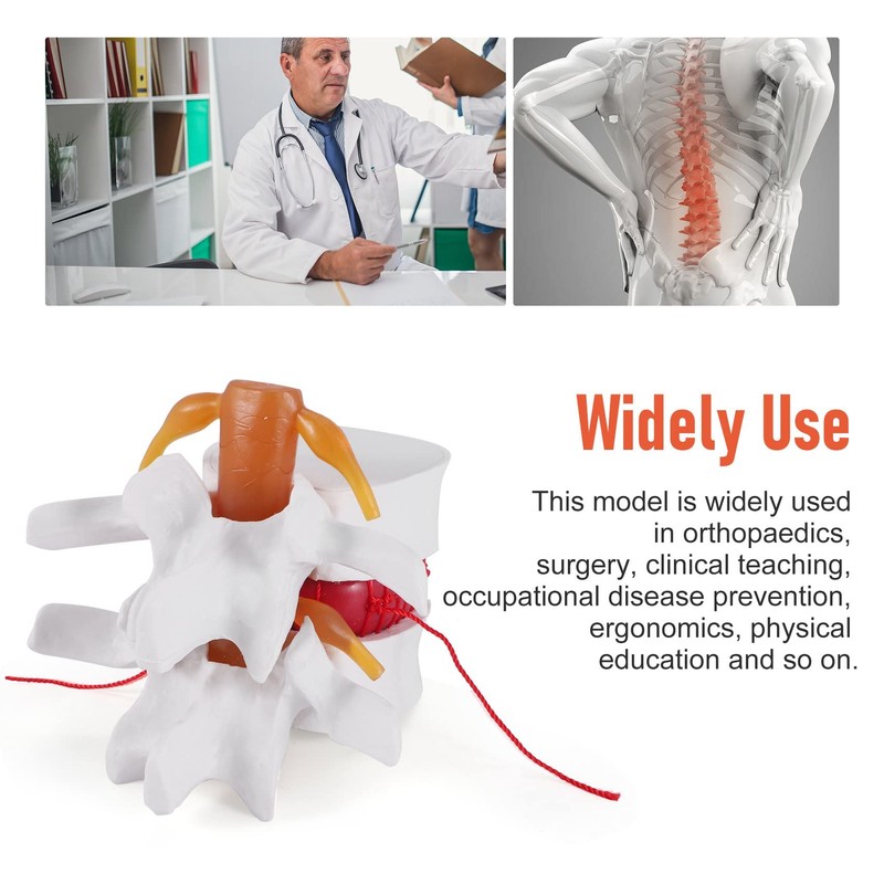 TOBEOME 1:1.5 Human Demonstration Model for Herniated Disc of the