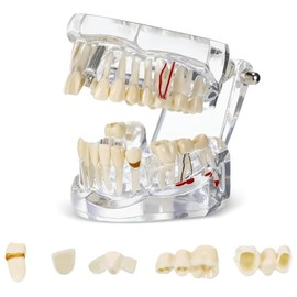 Fahgaer Disease Teeth Model Dental Typodonts Implant Teeth Model with Removable Teeth Dentist Standard Tooth Demonstration