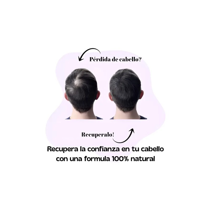 Fortipelo Kit Anticaída Shampoo Con Papa Romero Sábila Chile