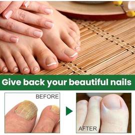 Ginger Nail, Tratamiento de Uñas con Jengibre, Soporte para Uñas | Cuidado de Uñas, Suero para El Crecimiento de Uñas con Jengibre, Aceite Fortalecedo