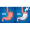 Melox for Heartburn Relief