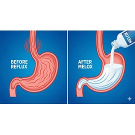 Melox for Heartburn Relief