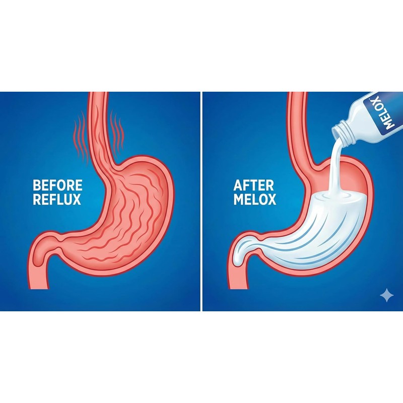 Melox for Heartburn Relief