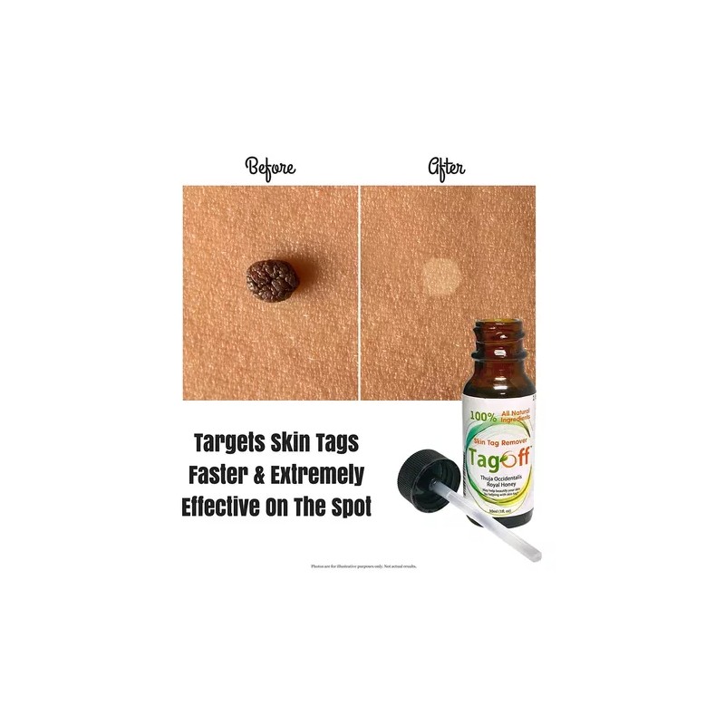 Tagoff Remueve Naturalmente Verrugas Sin Dolor Ni Cicatrices