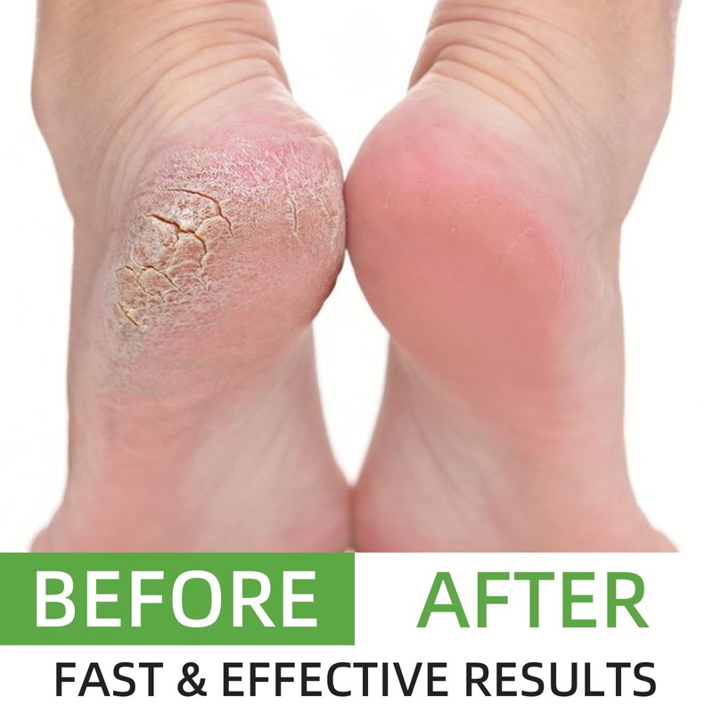 AOPEIBOTO Urea Cream 60 Percent for Feet Maximum Strength, Cracked