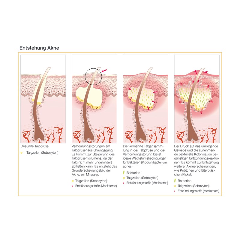 AESTHETICO vital care - Purifying Healing Mask for Acne/Blemished Skin,