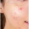Skin Care/Serum/Vitamin/B/C/Bag/Face/-/Niacinamide/10%/Zinc/1%/K/Beauty