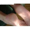 Naturprodukte Schwarz - Callus Ex - Callus Remover and Foot