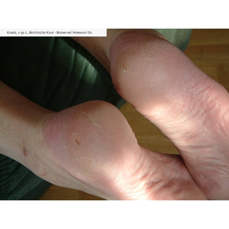 Naturprodukte Schwarz - Callus Ex - Callus Remover and Foot