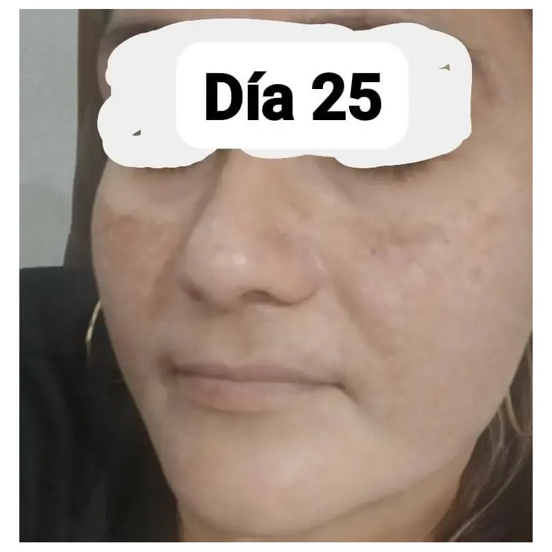 Crema Despigmentante Aclara Piel Acné Manchas Paño Melasma