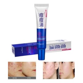 Crema Anti Acné Bioaqua Zona Localizada Piel Grasa Puntos