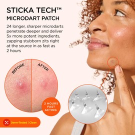 ZitSticka Extra Strength Killa Acne Patches for Face - World's Most Potent Pimple Patch with Fast-Acting Microdarts - Starts Working within 2 Hours for Deep, Early-Stage Zits & Blemish - 4 Count