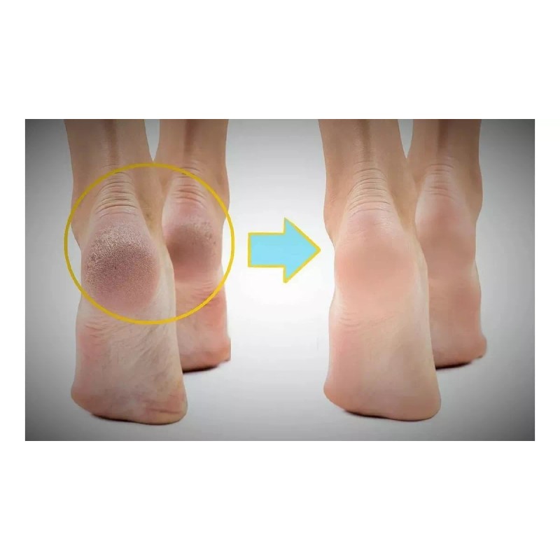 KFMX 12 Mascarilla Exfoliante Pies Elimina Callosidades Humectant