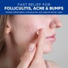 Crema Para El Tratamiento De La Foliculitis Y El Acné