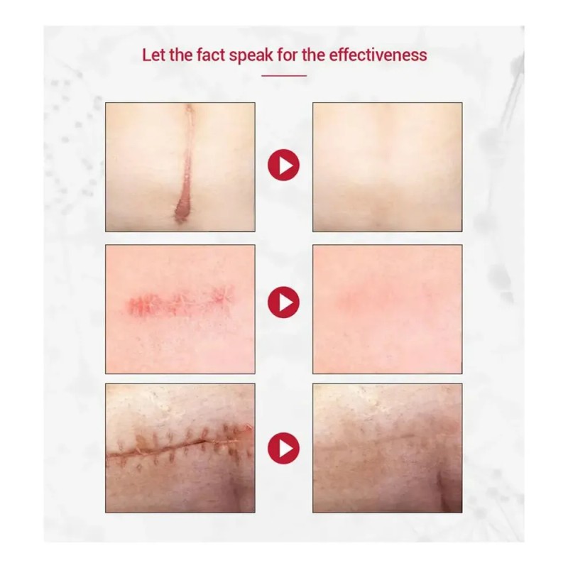 /gz' Crema Para Eliminar Cicatrices, Estrías, Quemaduras,+