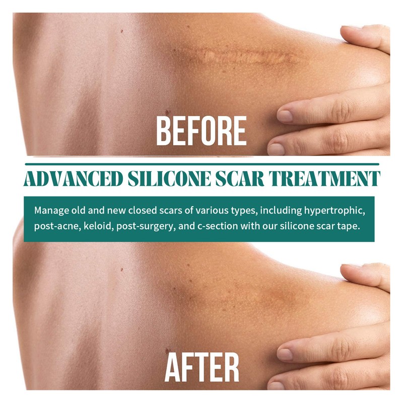 Scar Tape Roll Multifunctional Silicone Safe Scar Removal Strip for