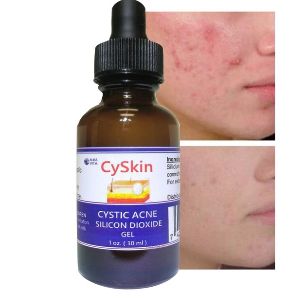 Acne Cystic Skin Treatment Cyskin Gel  Silicon Dioxide Fast Results By ALKAVITA