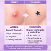 Parches Para Acné Y Espinillas Forma Estrella Aurany 4pcs