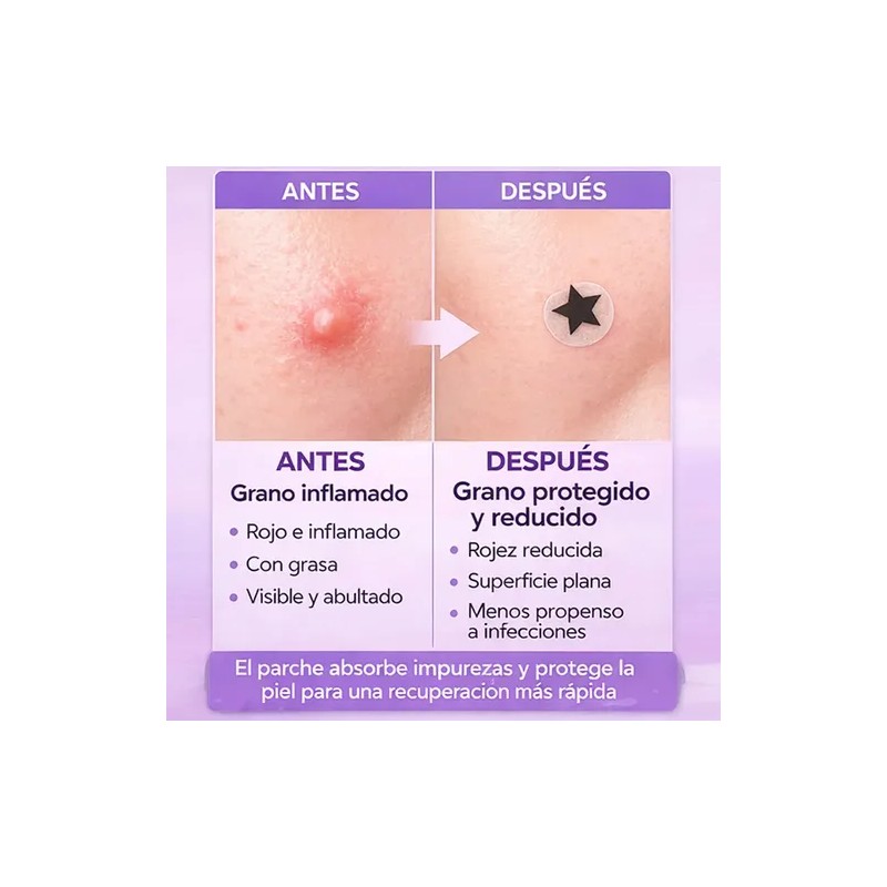 Parches Para Acné Y Espinillas Forma Estrella Aurany 4pcs