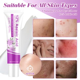 llikknve 12% Azelaic Acid Cream,Rosacea Cream for Face,Revitalize Your Complexion Facial Serum,Gentle and Moisturizing for all Skin Pigmentation Redness