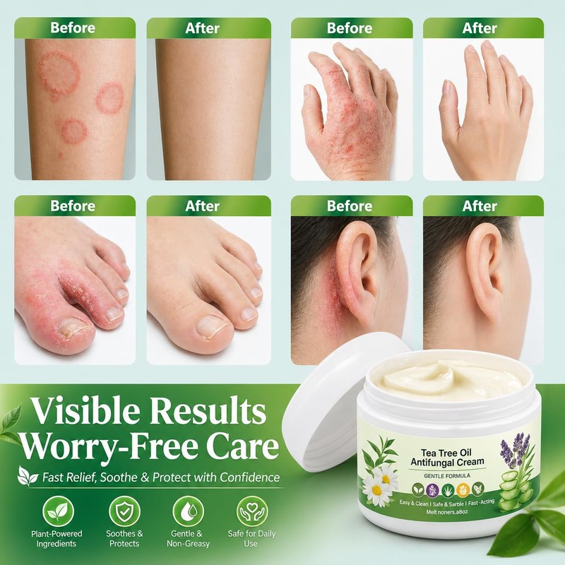 Tea Tree Oil Cream for Fungal-Prone Skin – Suitable for