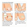 Professional Toenail Correction Paronychia Nail Sticker Correction Ingrown Pincer Toenail