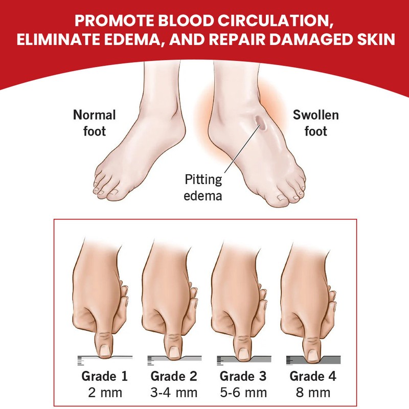 Leg Swelling Relief Cream – Edema Support Lotion for Tired,