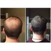 4X Advanced Anti Hair Loss Treatment DHT Blocker Fast Growth
