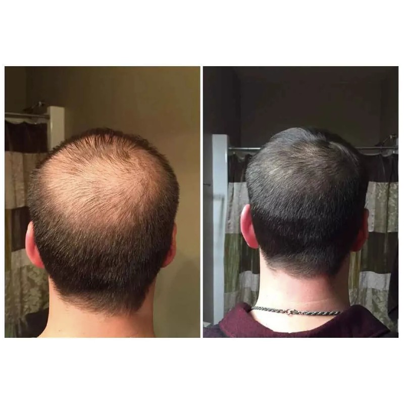 4X Advanced Anti Hair Loss Treatment DHT Blocker Fast Growth