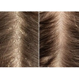 Shampoo Adiós Caspa Sheló Elimina Resequedad Restaura Cabell