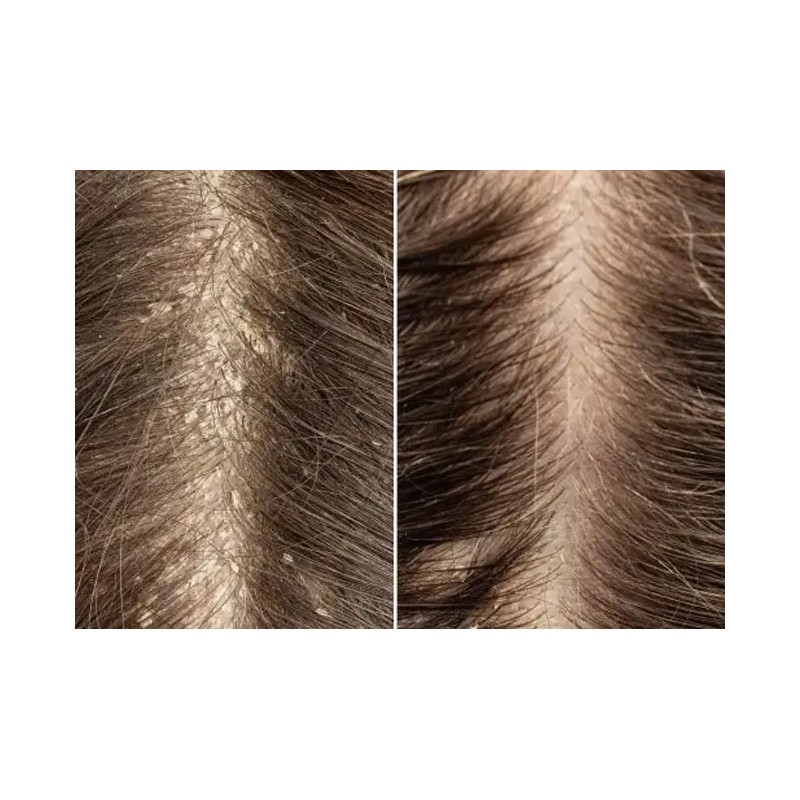 Shampoo Adiós Caspa Sheló Elimina Resequedad Restaura Cabell